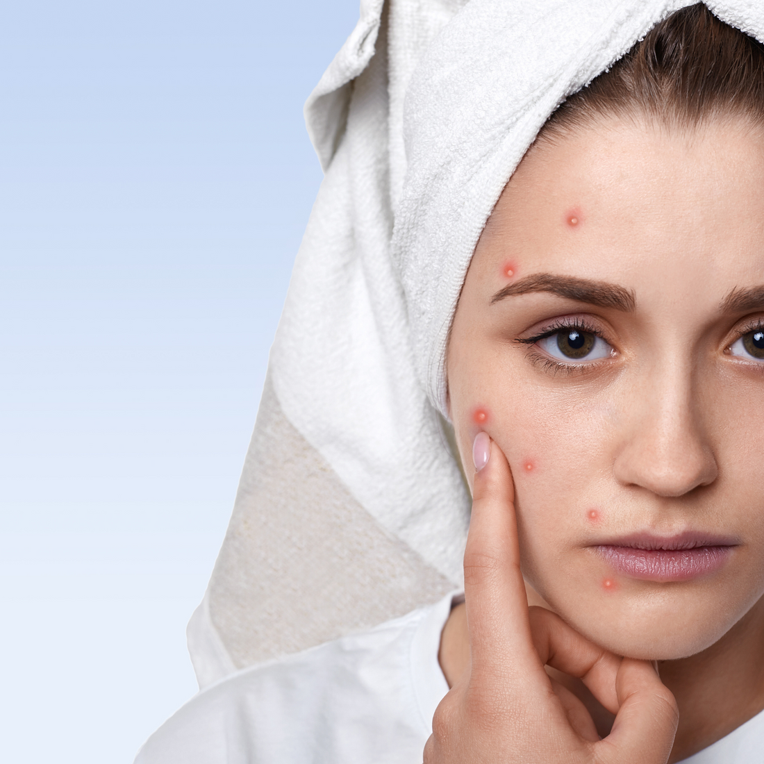 Stop Touching Your Face: The Science Behind Why It’s the Worst Habit for Acne