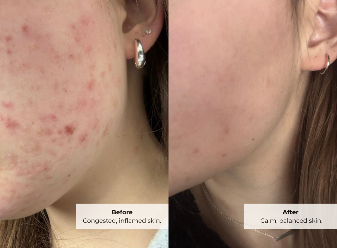 Before and after comparison of using Cocoon products for acne